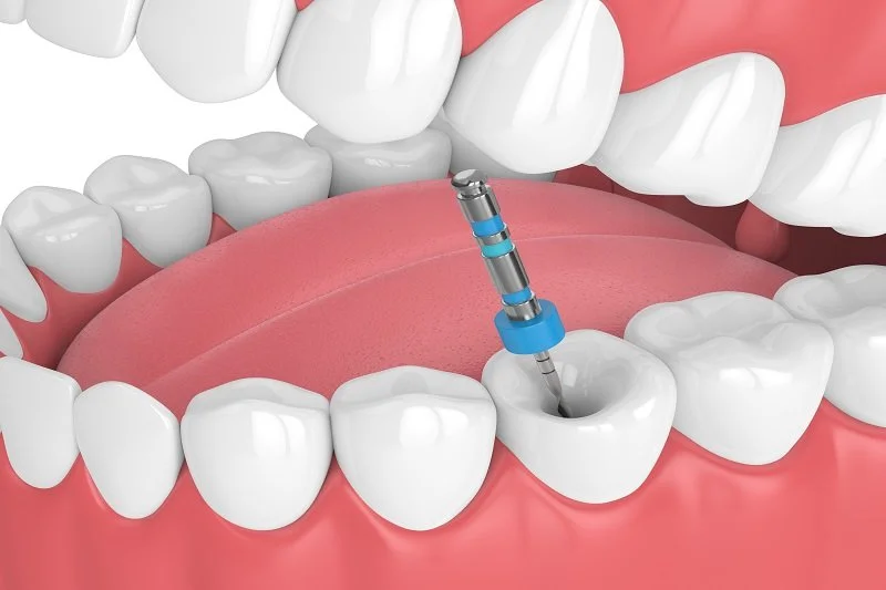 Single Sitting Root Canal Treatment