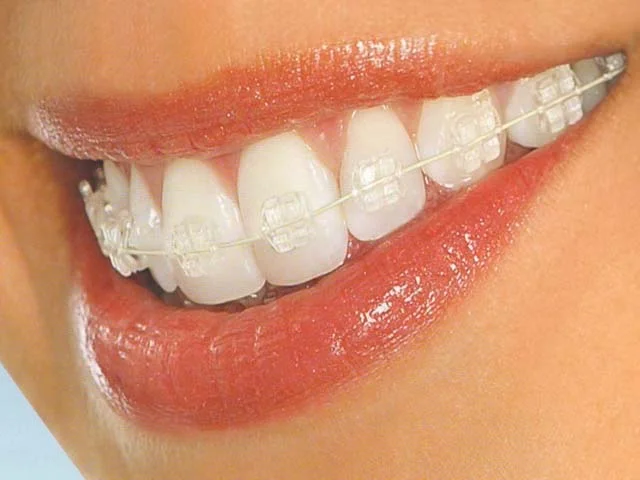 INVISALIGN (Invisible Braces)
