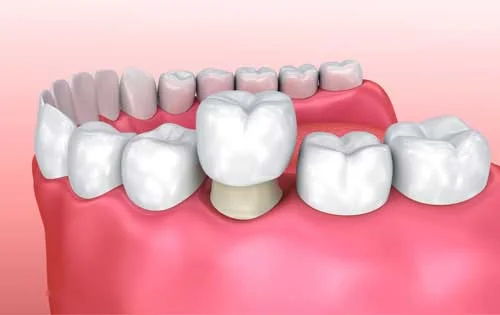 Ceramic Crowns
