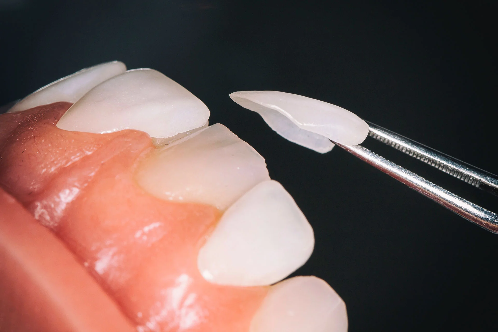 Laminates and Veneers
