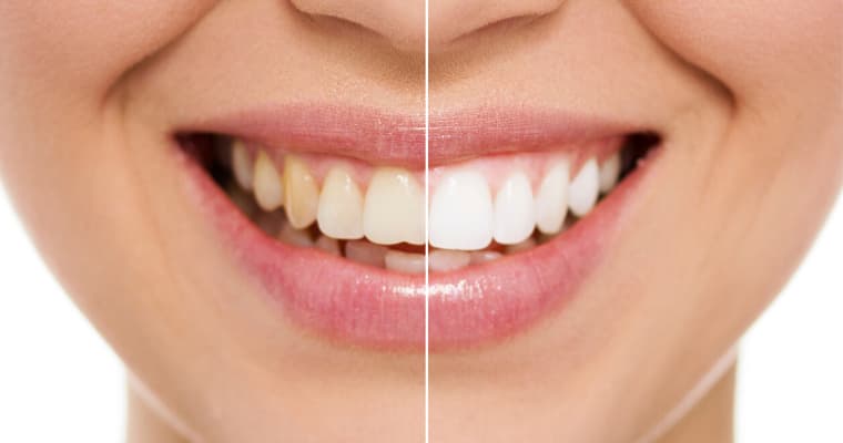 Bleaching / Teeth Whitening