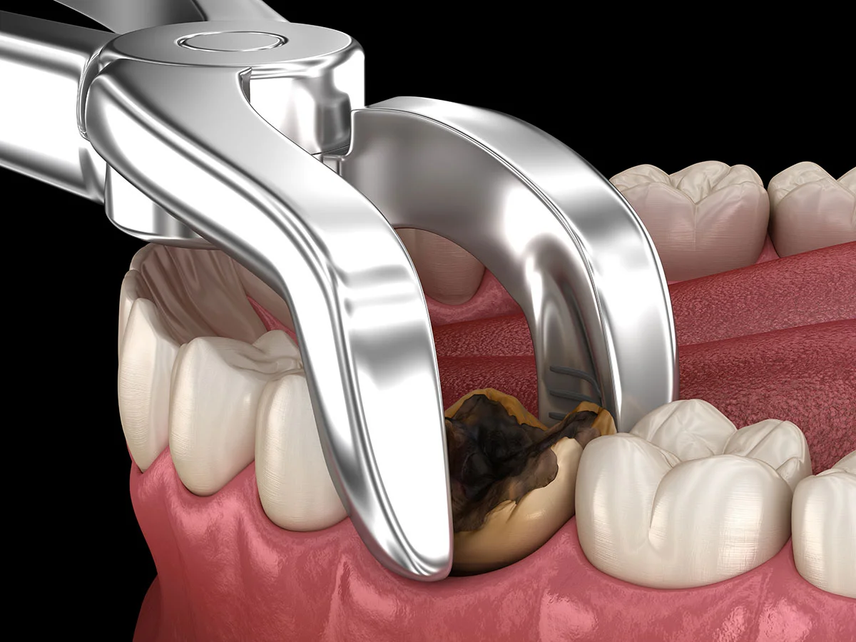 Surgical Extraction