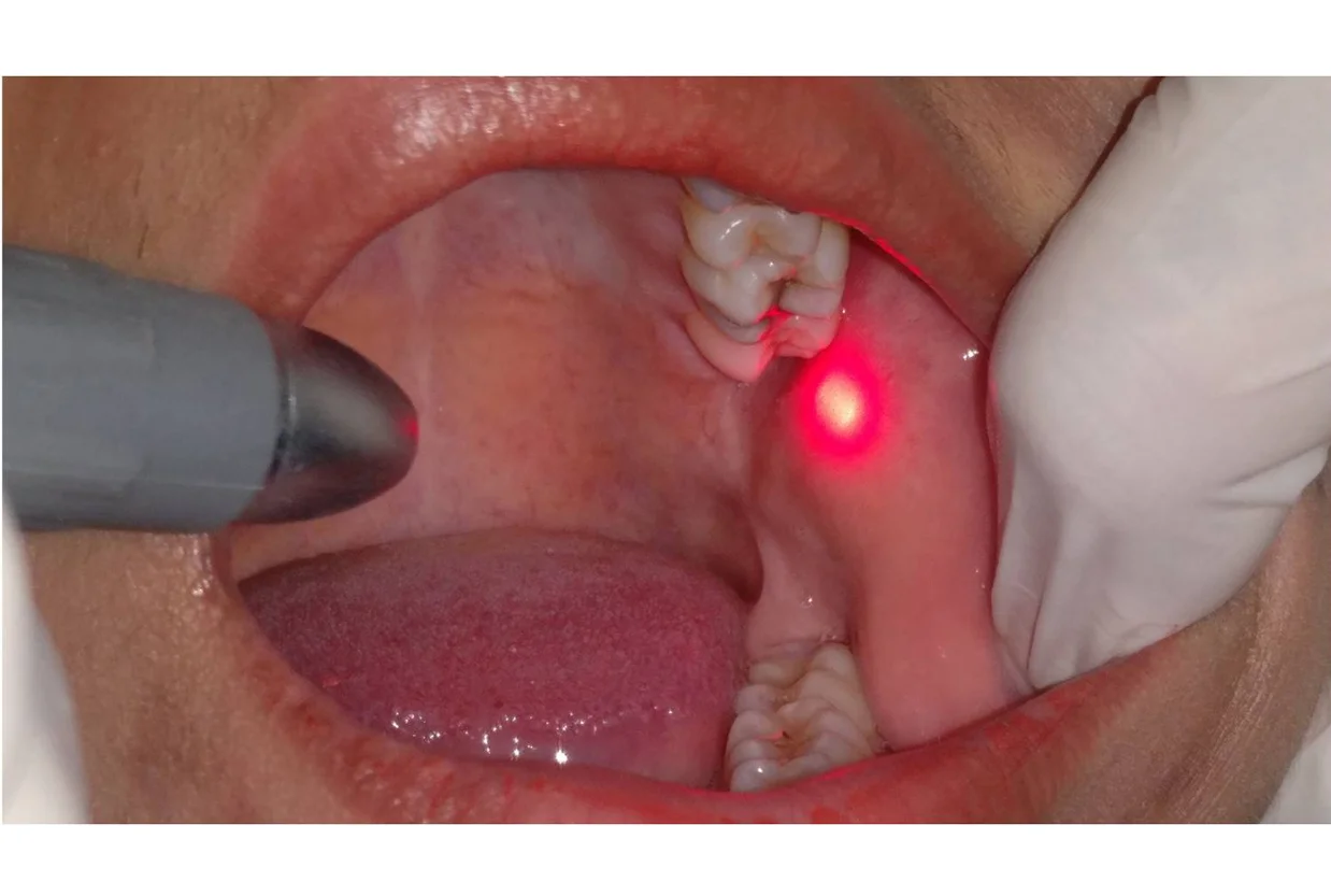Laser Dentistry