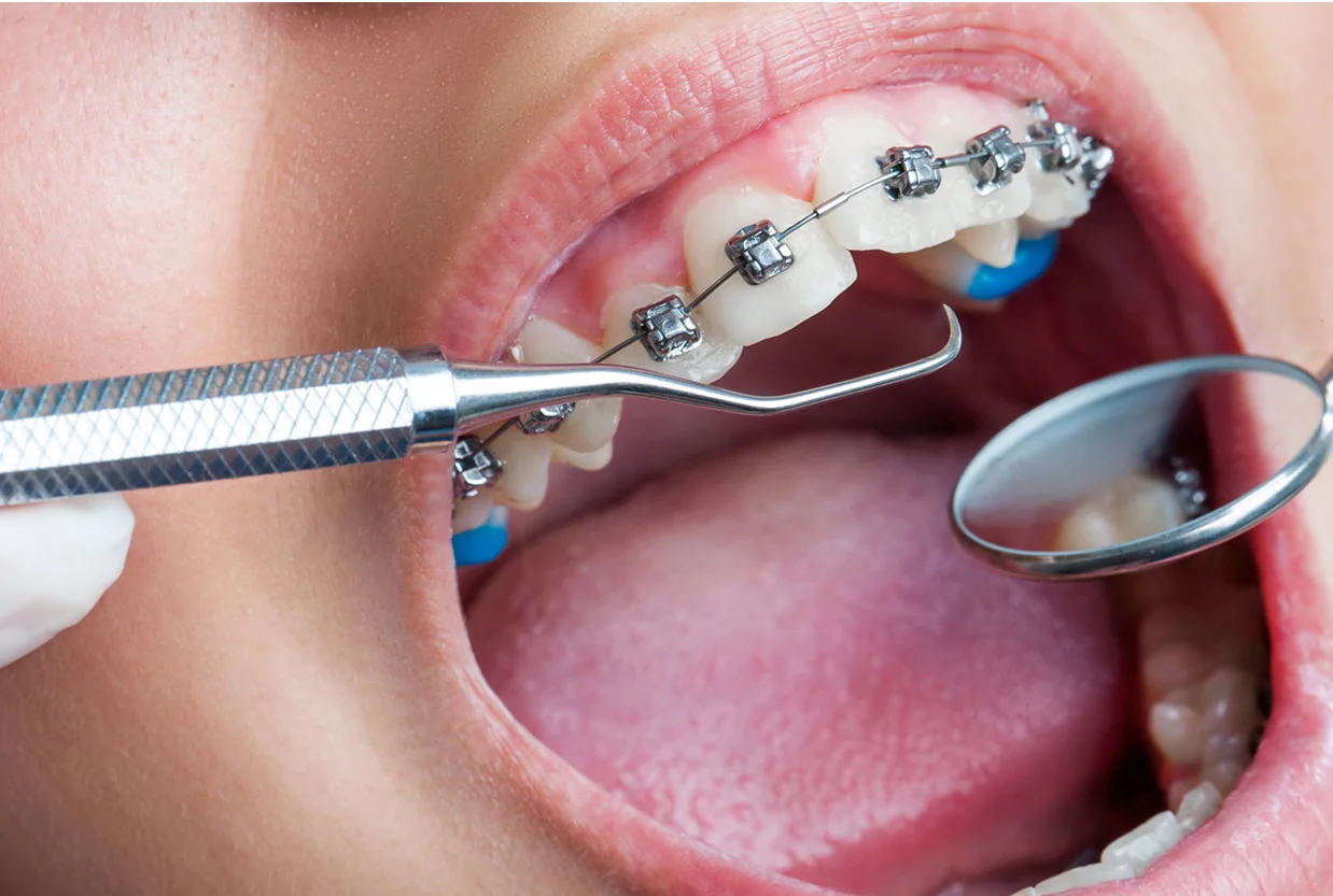 Conventional Braces